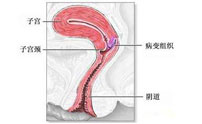 什么是宫颈癌